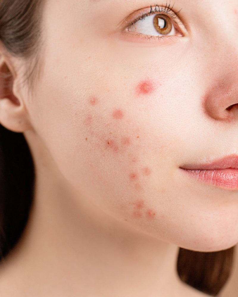 Acne & Blemishes